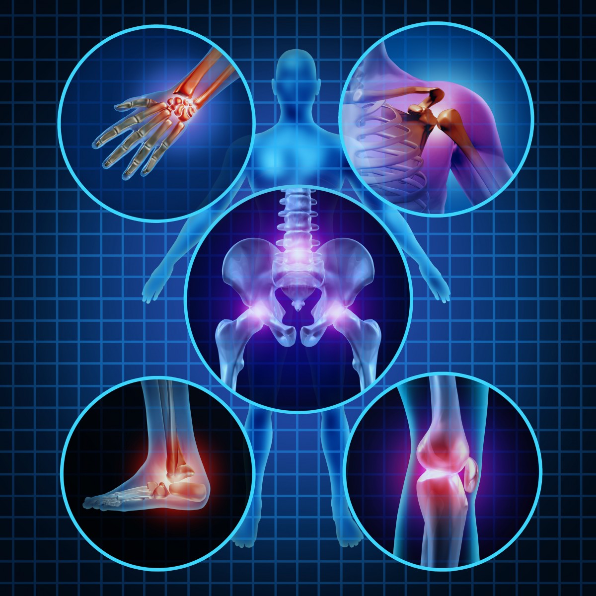 What Allows Remission in Patients with Early Rheumatoid Arthritis?