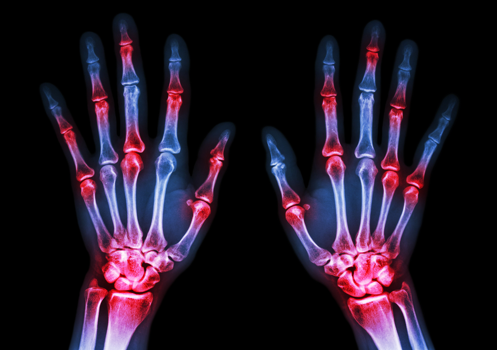 Wondering Why RA Treatments Only Work on Certain Joints? DNA Methylation May Hold an Answer