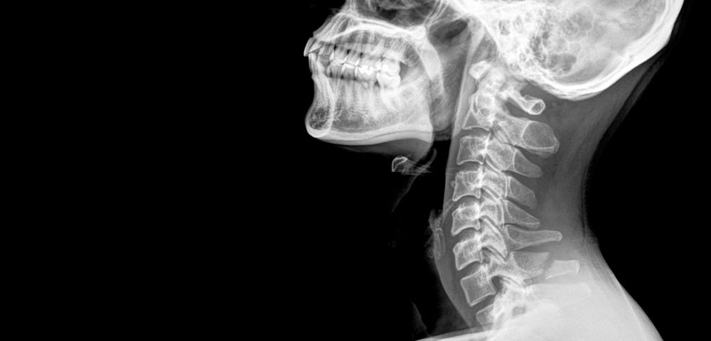 Predictors Identified for Severe Cervical Spine Instabilities in RA Patients